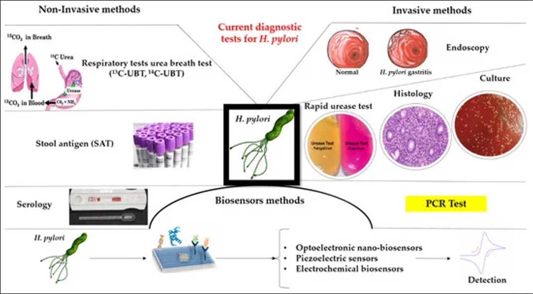 Methods for Detecting&nbsp;Helicobacter pylori: A Comparative Analysis of Accuracy and Advantages